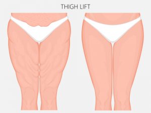 The Different Types Of Thigh Lift Procedures Compared